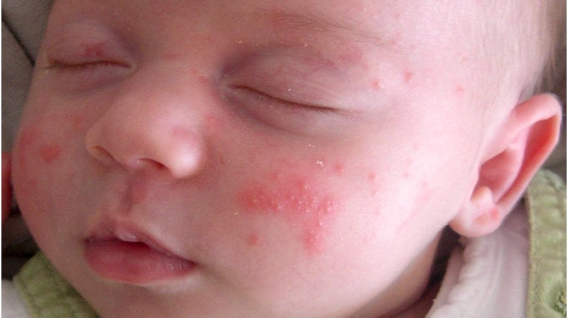 Skin Rashes On Toddlers